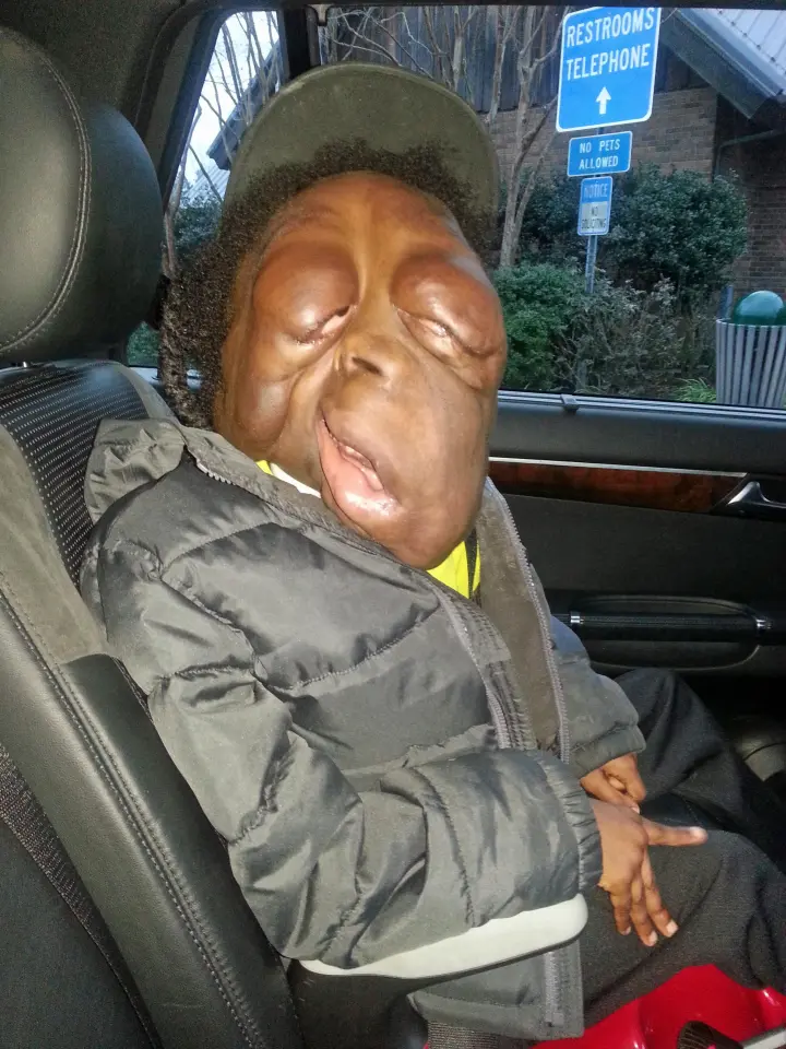 Amare Stover, eight, suffers from a rare condition called neurofibromatosis