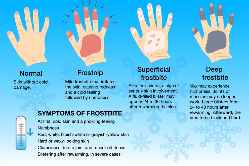 What is frostbite? How cold does it need to be to get frostbite and how fast does it occur?