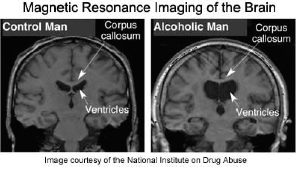 Alcohol Consumption Leads to Brain Shrinkage – How Alcoholism Ruins Up Your Brain